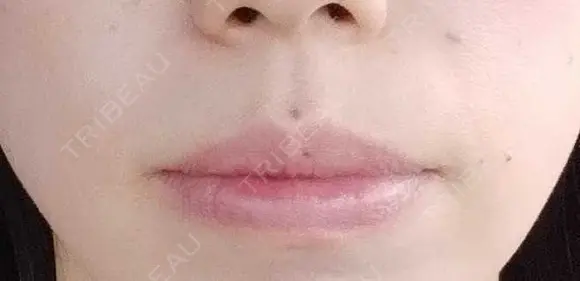 ボトックス（口角） YBC横浜美容外科 大宮院 DAY 39 メイン用