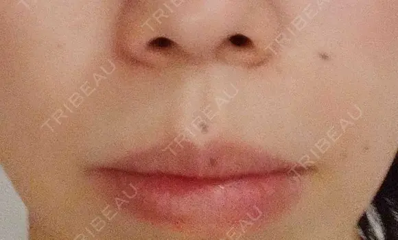 ボトックス（口角） YBC横浜美容外科 大宮院 DAY 40 メイン用