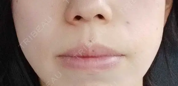 ボトックス（口角） YBC横浜美容外科 大宮院 DAY 42 メイン用