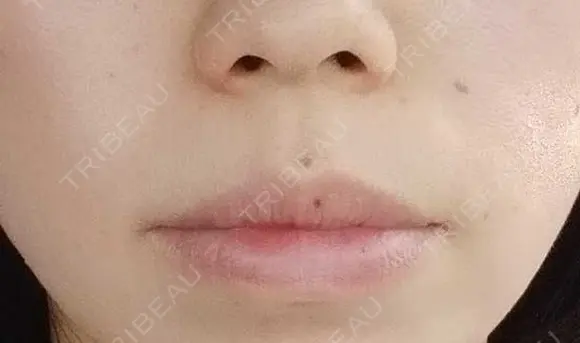 ボトックス（口角） YBC横浜美容外科 大宮院 DAY 43 メイン用