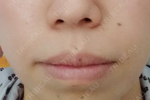 ボトックス（口角） YBC横浜美容外科 大宮院 AFTER メイン用