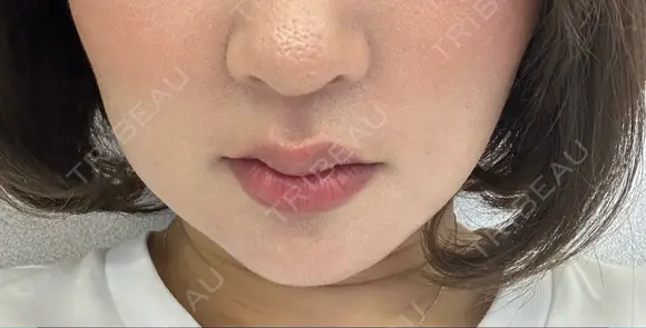 ニードルRF（ポテンツァなど） ゆう美容クリニック DAY 10 メイン用