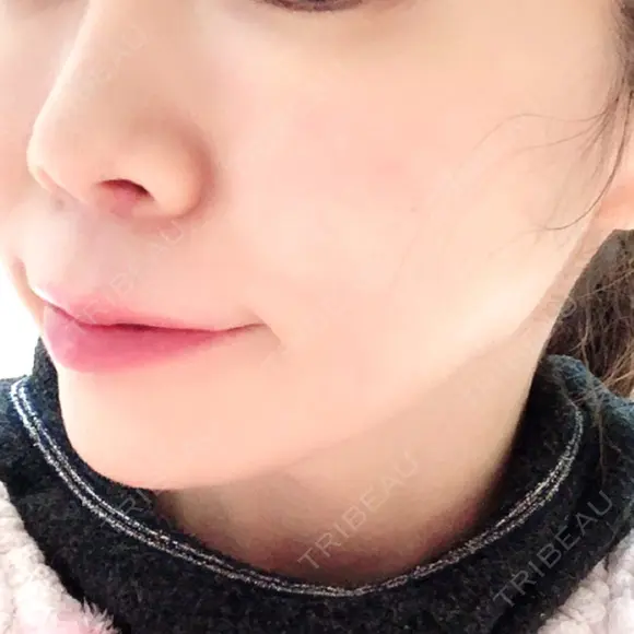 ヒアルロン酸注入（あご） TCB東京中央美容外科 世田谷院 AFTER メイン用