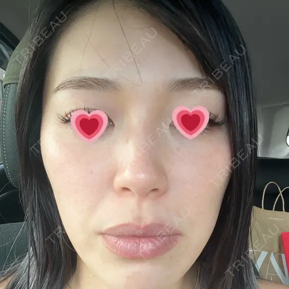 光治療（フォトフェイシャルなど） APOLLO BEAUTY CLINIC DAY 8 メイン用