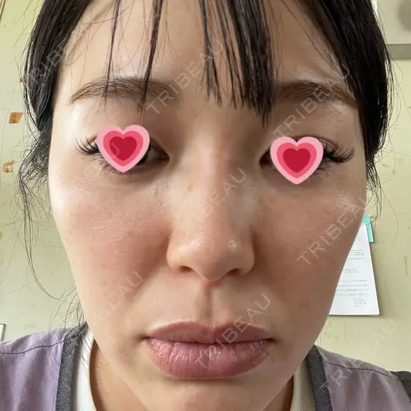 光治療（フォトフェイシャルなど） APOLLO BEAUTY CLINIC DAY 9 メイン用