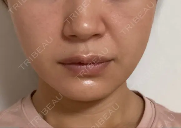 糸リフト / ヒアルロン酸注入（あご） ブルームクリニック（BLOOM CLINIC） DAY 59 メイン用