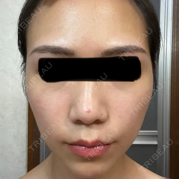 ボトックス（口角） / ボトックス（人中） L‘amour clinic Tokyo【ラムールクリニック東京】 AFTER メイン用