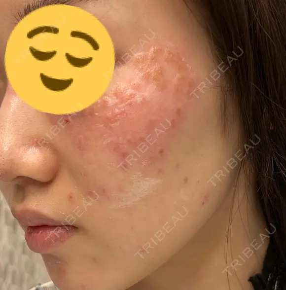 シミ取りレーザー CLINICA BellaForma DAY 0 メイン用