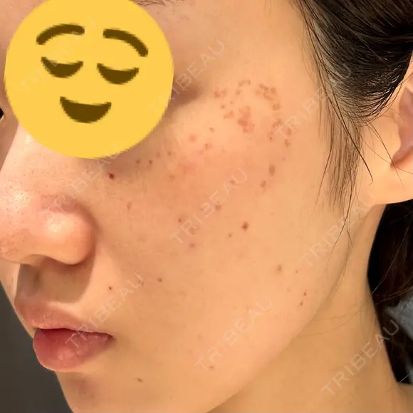 シミ取りレーザー CLINICA BellaForma DAY 2 メイン用