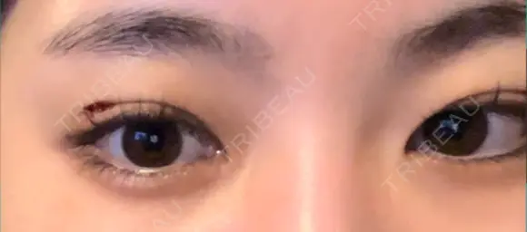 その他（目元） / 上まぶたの脂肪取り 9BeautyClinic DAY 0 メイン用