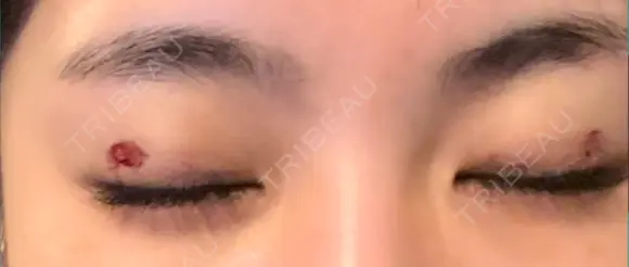 その他（目元） / 上まぶたの脂肪取り 9BeautyClinic DAY 0 メイン用