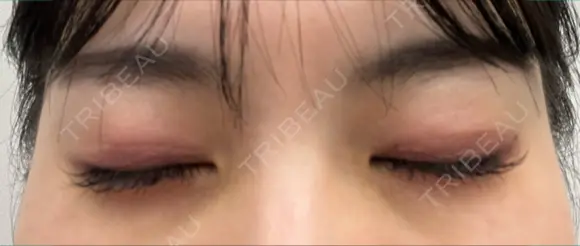 その他（目元） / 上まぶたの脂肪取り 9BeautyClinic DAY 5 メイン用