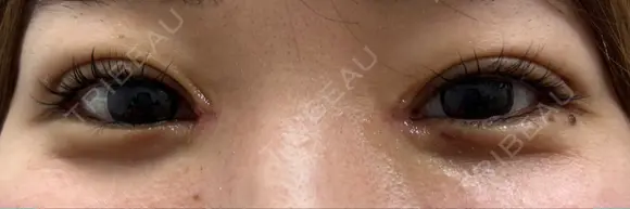 二重埋没 / 目頭切開 9BeautyClinic DAY 5 メイン用