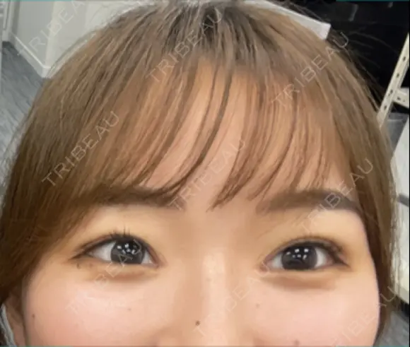 二重埋没 / 目頭切開 9BeautyClinic DAY 31 メイン用