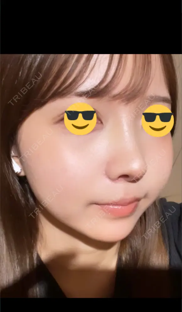 鼻尖形成（切開） / 小鼻縮小（切開） / 軟骨移植 / 鼻柱下降・鼻唇角形成（猫手術） / ヒアルロン酸注入（あご） グローバルビューティークリニック 東京院 DAY 7 メイン用