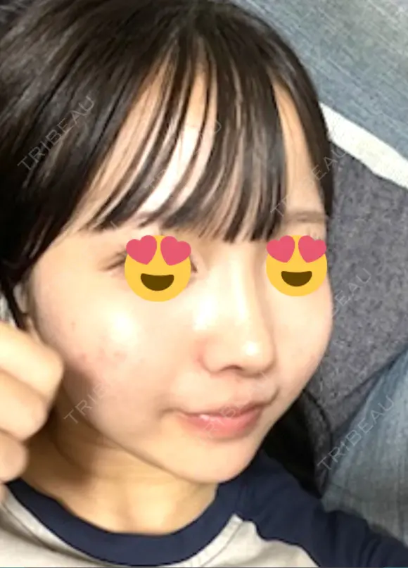 鼻尖形成（切開） / 小鼻縮小（切開） / 軟骨移植 / 鼻柱下降・鼻唇角形成（猫手術） / ヒアルロン酸注入（あご） グローバルビューティークリニック 東京院 DAY 16 メイン用