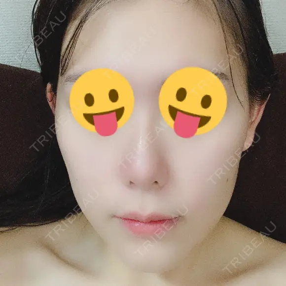 骨切り（あご） / 脂肪吸引（顔） / セットバック / ルフォー+ssro（両あご) リッツ美容外科 東京院 DAY 21 メイン用