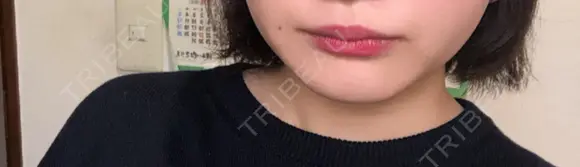 ボトックス（口角） 湘南美容クリニック 大宮院 AFTER メイン用