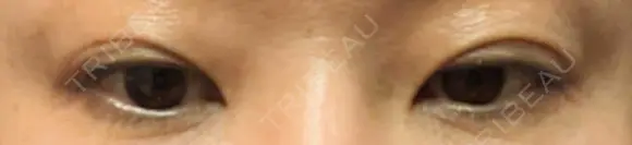 アートメイク（アイライン） Tokyo Tensei Clinic 新宿院 DAY 14 メイン用