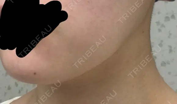 脂肪溶解注射（顔） / PRP皮膚再生療法 聖心美容クリニック 六本木院 DAY 16 メイン用