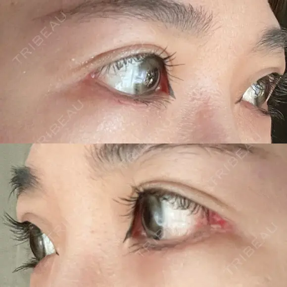 目尻切開 / タレ目形成・グラマラスライン（切開） 銀座高須クリニック DAY 30 メイン用