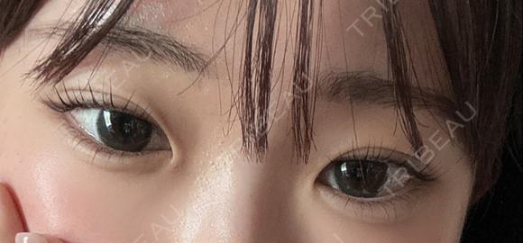 ヒアルロン酸注入（涙袋） 恵聖会クリニック 心斎橋院 AFTER メイン用
