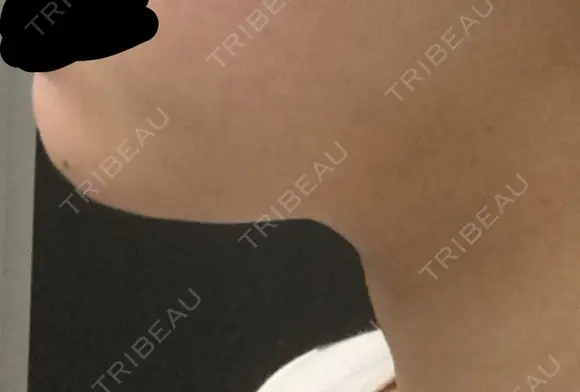 脂肪溶解注射（顔） / PRP皮膚再生療法 聖心美容クリニック 六本木院 DAY 16 メイン用