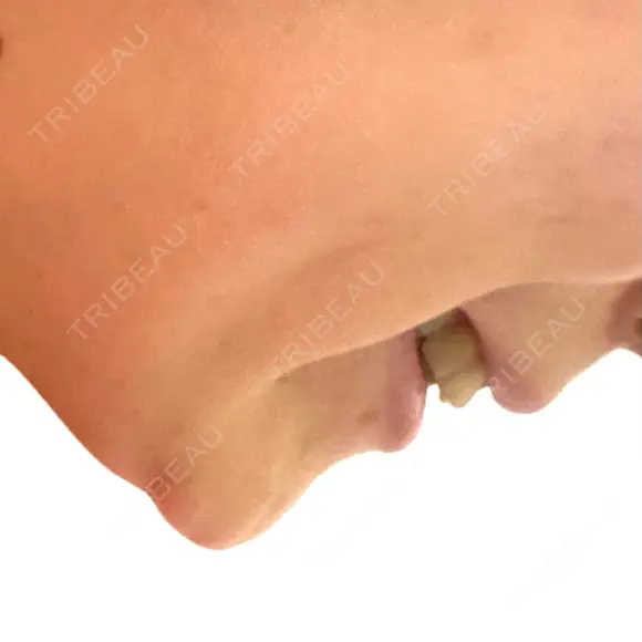 脂肪溶解注射（顔） TCB東京中央美容外科 千葉駅前院 BEFORE メイン用