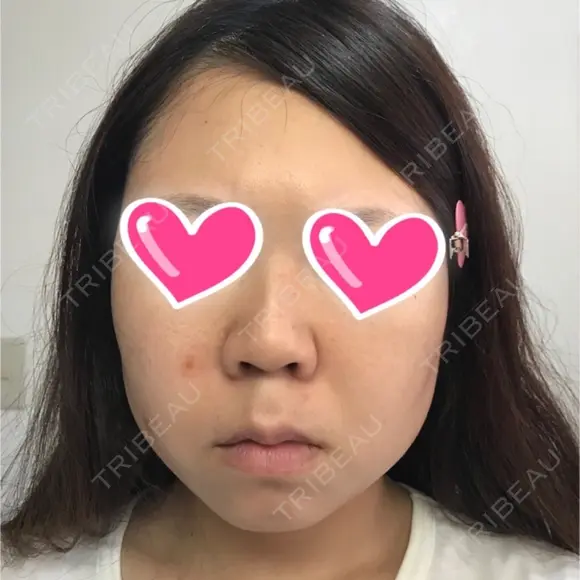 隆鼻術 / 鼻尖形成（切開） / 鼻中隔延長（切開） / 小鼻縮小（切開） ザ・プラス美容外科 BEFORE メイン用