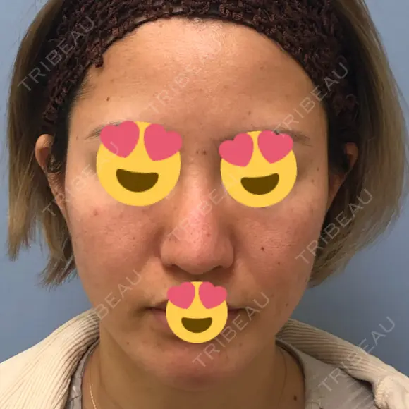 ピーリング（ニキビ・毛穴） / ダーマペン 表参道スキンクリニック 名古屋院（DAILY SKIN CLINIC提携院） BEFORE メイン用