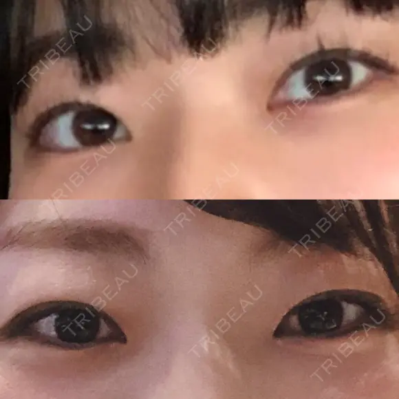 二重切開 松下皮フ形成外科 BEFORE メイン用