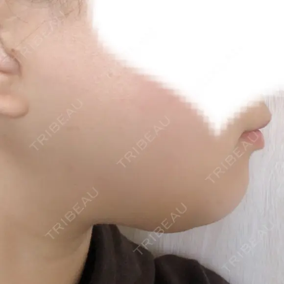 その他（輪郭） リラ・クラニオフェイシャル・クリニック BEFORE メイン用