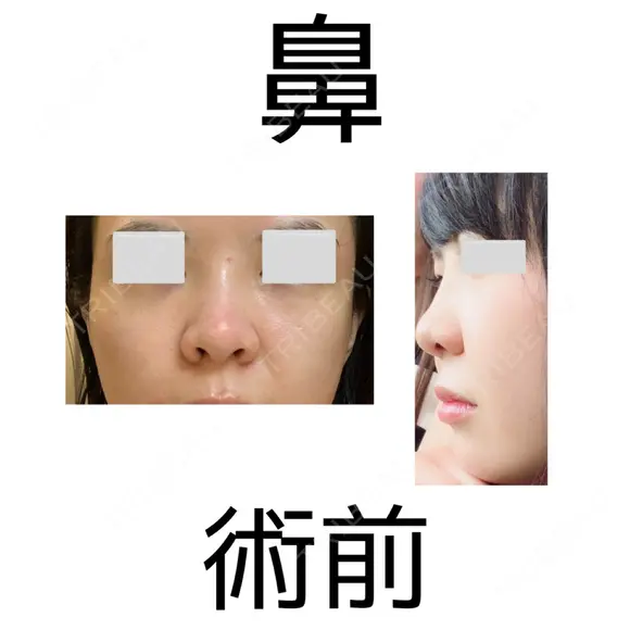 鼻尖形成（切開） / 鼻中隔延長（切開） / 軟骨移植 eクリニック 金沢本院 BEFORE メイン用