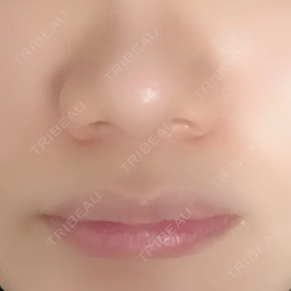 小鼻縮小（切開） ながしまクリニック BEFORE メイン用