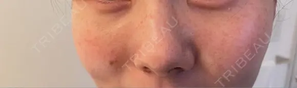 美肌レーザー / シミ取りレーザー たかはし形成外科･美容外科  BEFORE メイン用