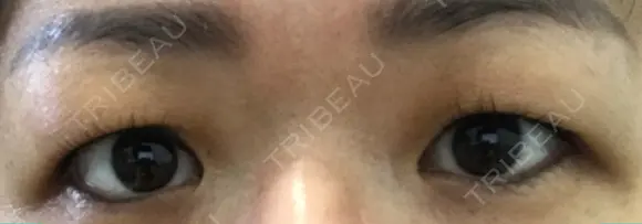 眉下切開 湘南美容クリニック 大阪京橋院 BEFORE メイン用