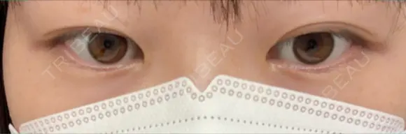 二重埋没 リオラビューティークリニック 柏院 BEFORE メイン用
