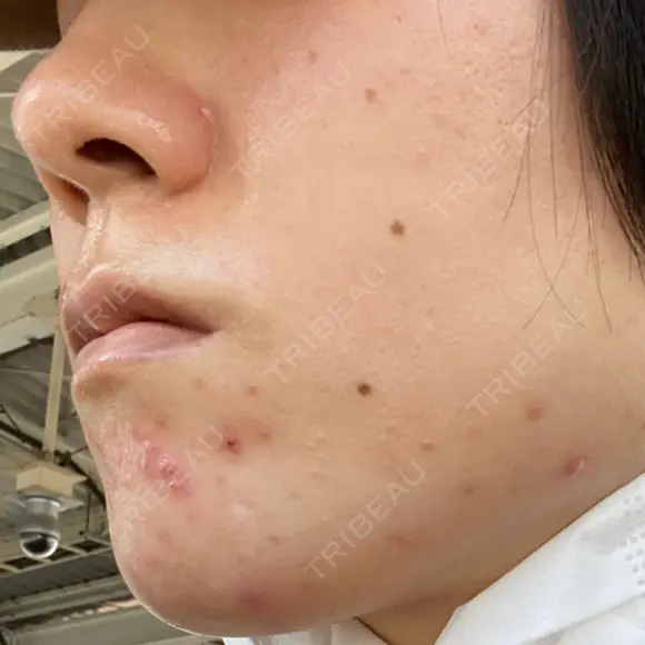 ダーマペン AURORA CLINIC（オーロラクリニック）新宿院 BEFORE メイン用