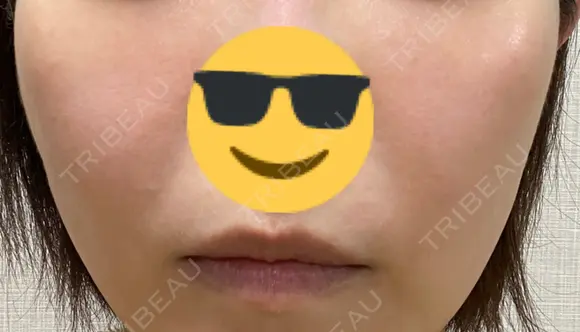 シミ取りレーザー PICO BEAUTY CLINIC BEFORE メイン用