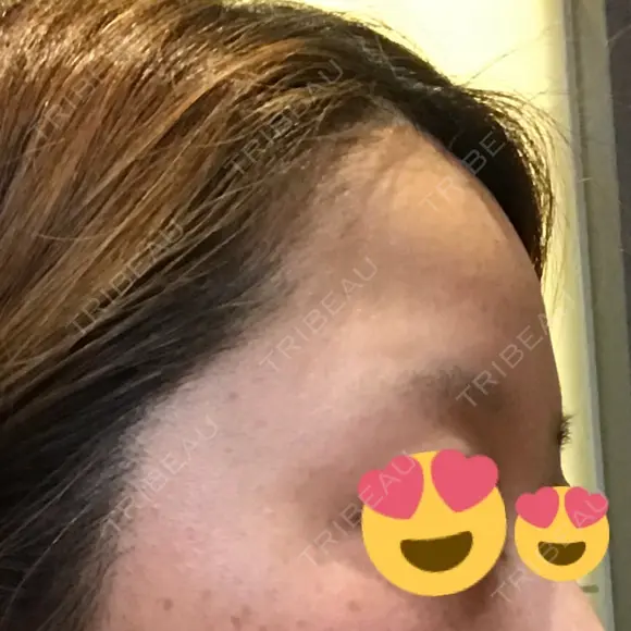 額を丸く ニューセンス皮膚科クリニック BEFORE メイン用