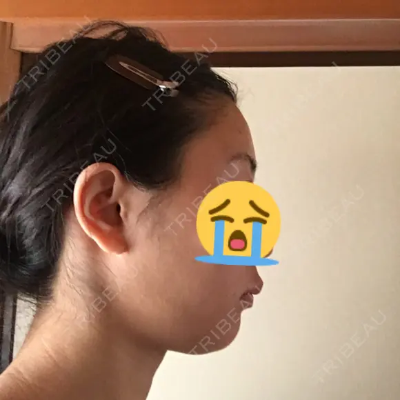脂肪吸引（顔） ヴェルトラクリニック 大阪院 BEFORE メイン用
