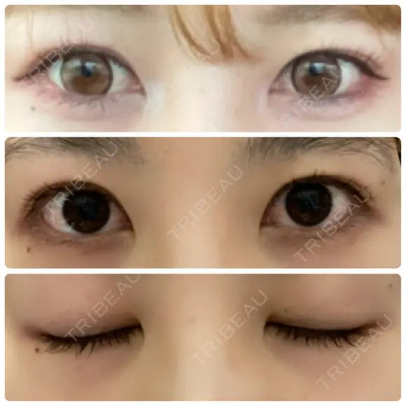 二重切開 / 上まぶたたるみ取り 城本クリニック 姫路院 BEFORE メイン用