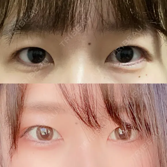 二重埋没 / 自然癒着法 シンデレラ＆ダヴィンチクリニック BEFORE メイン用