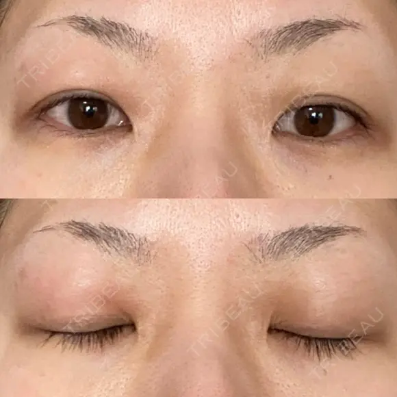 二重埋没 / 自然癒着法 シンデレラ＆ダヴィンチクリニック BEFORE メイン用
