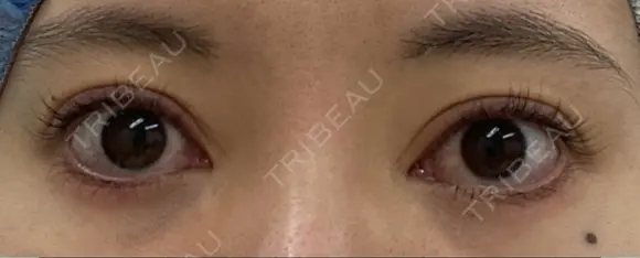 目尻靭帯移動 こいずみ形成クリニック名古屋 BEFORE メイン用