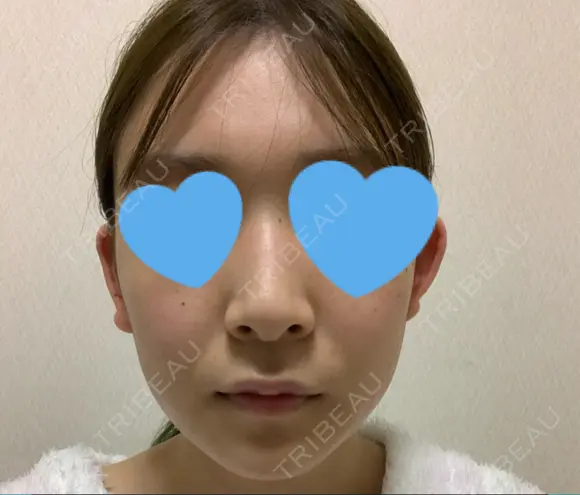 光治療（フォトフェイシャルなど） アムルーズ美容外科クリニック 大阪院 BEFORE メイン用