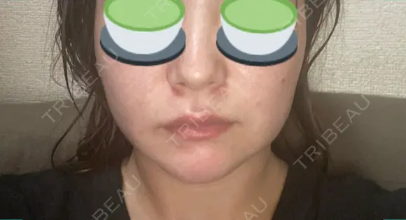 糸リフト 表参道スキンクリニック 表参道院 BEFORE メイン用