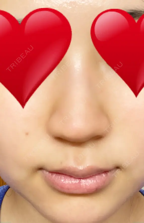 ヒアルロン酸注入（鼻） 新宿ビューティークリニック 新宿院 BEFORE メイン用