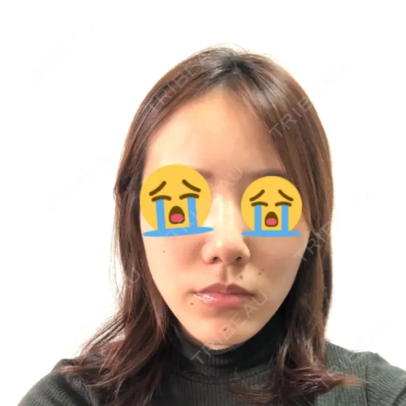 骨切り（あご） / 脂肪吸引（顔） 銀座マイアミ美容外科 BEFORE メイン用