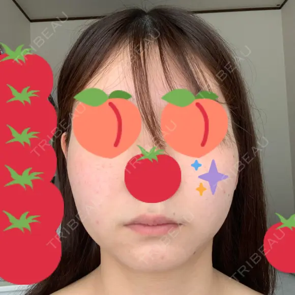 糸リフト / 脂肪吸引（顔） 湘南美容クリニック 大阪心斎橋院 BEFORE メイン用